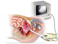 Ultrasound of the rectum About rectal ultrasound of the rectum