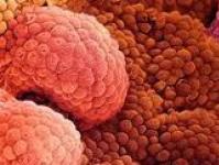 Prostate cancer: symptoms and treatment